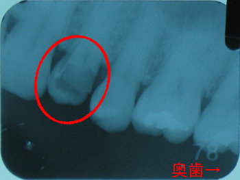 ファイル名: blog20120226-ToothXRayPhoto.jpeg
ファイルサイズ: 21.2KB blog20120226-ToothXRayPhoto