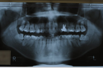 ファイル名: blog20120407-ToothXRay.jpeg
ファイルサイズ: 25.6KB blog20120407-ToothXRay